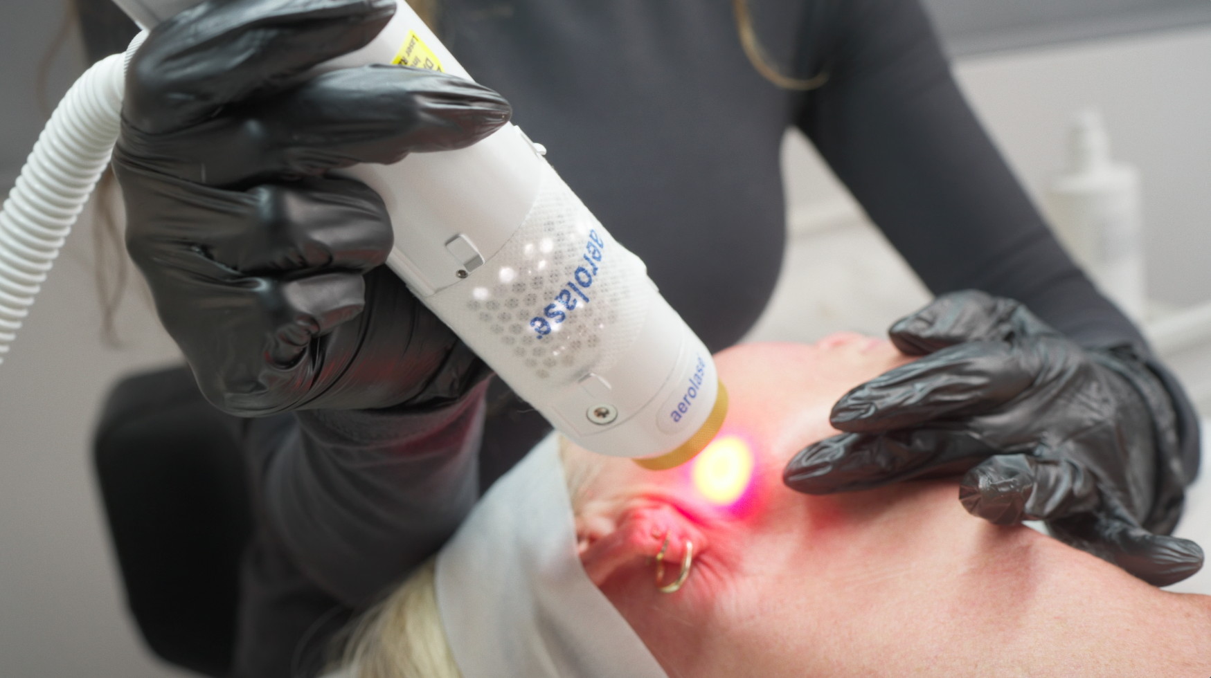 Aerolase ClearSkin Peel: A Smarter, More Effective Way to Treat Acne