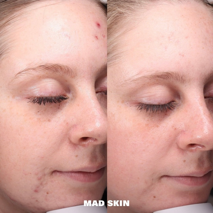 ClearSkin Peel Series