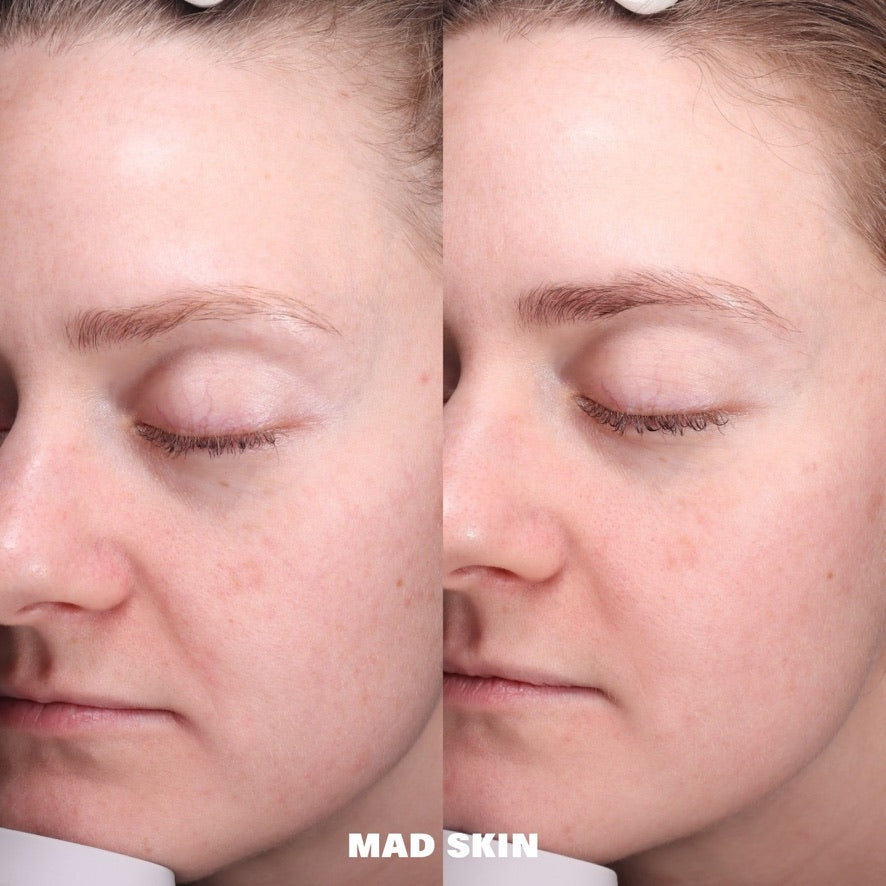 Morpheus8 Full-Face Rejuvenation 