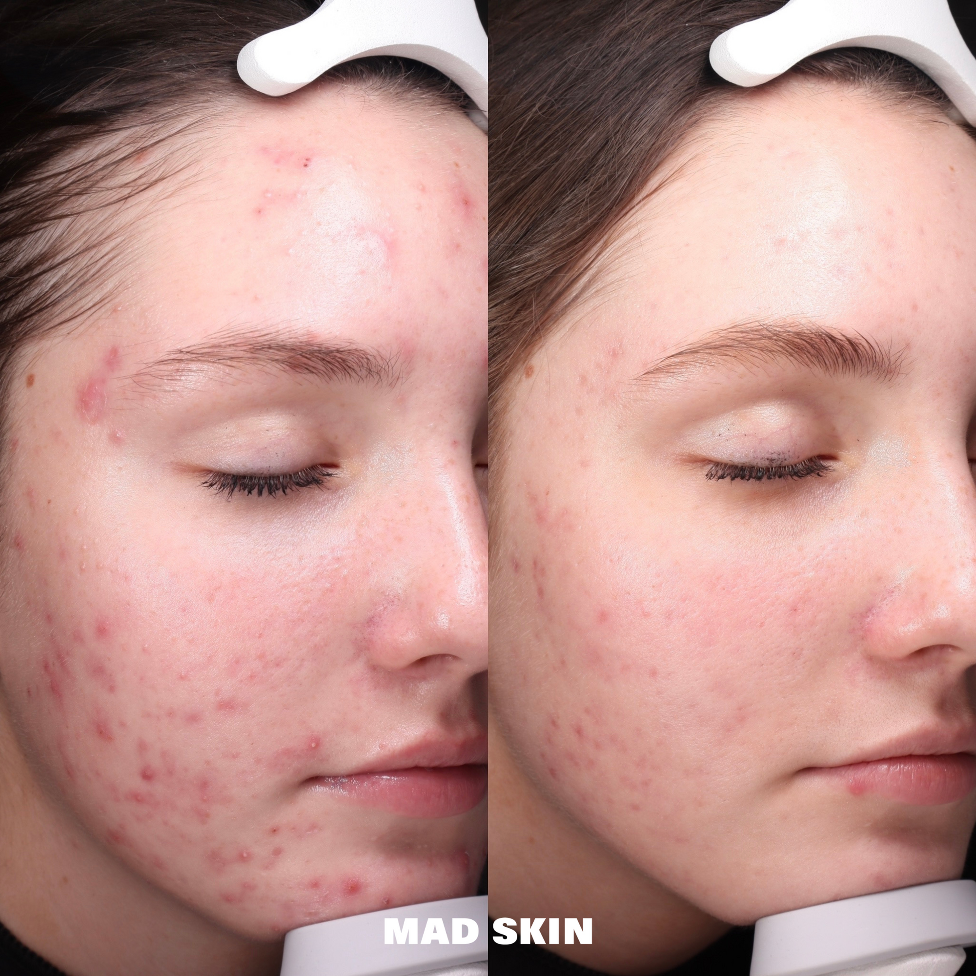 Aerolase ClearSkin Peel Series