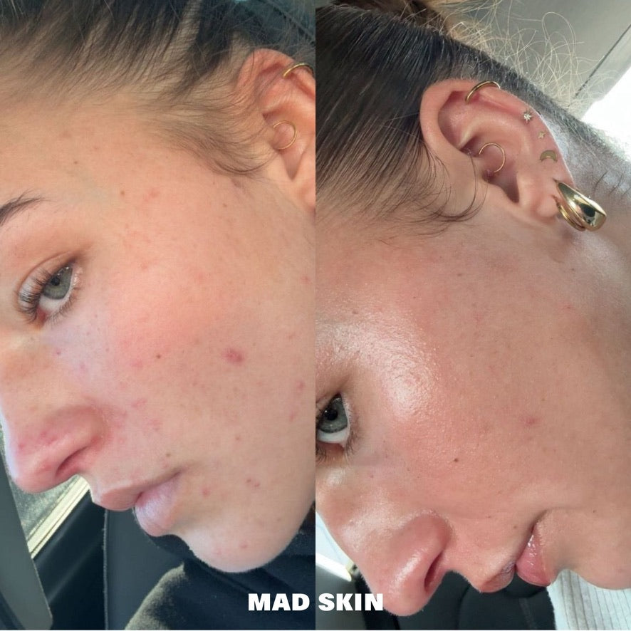 ClearSkin Peel - Single Treatment