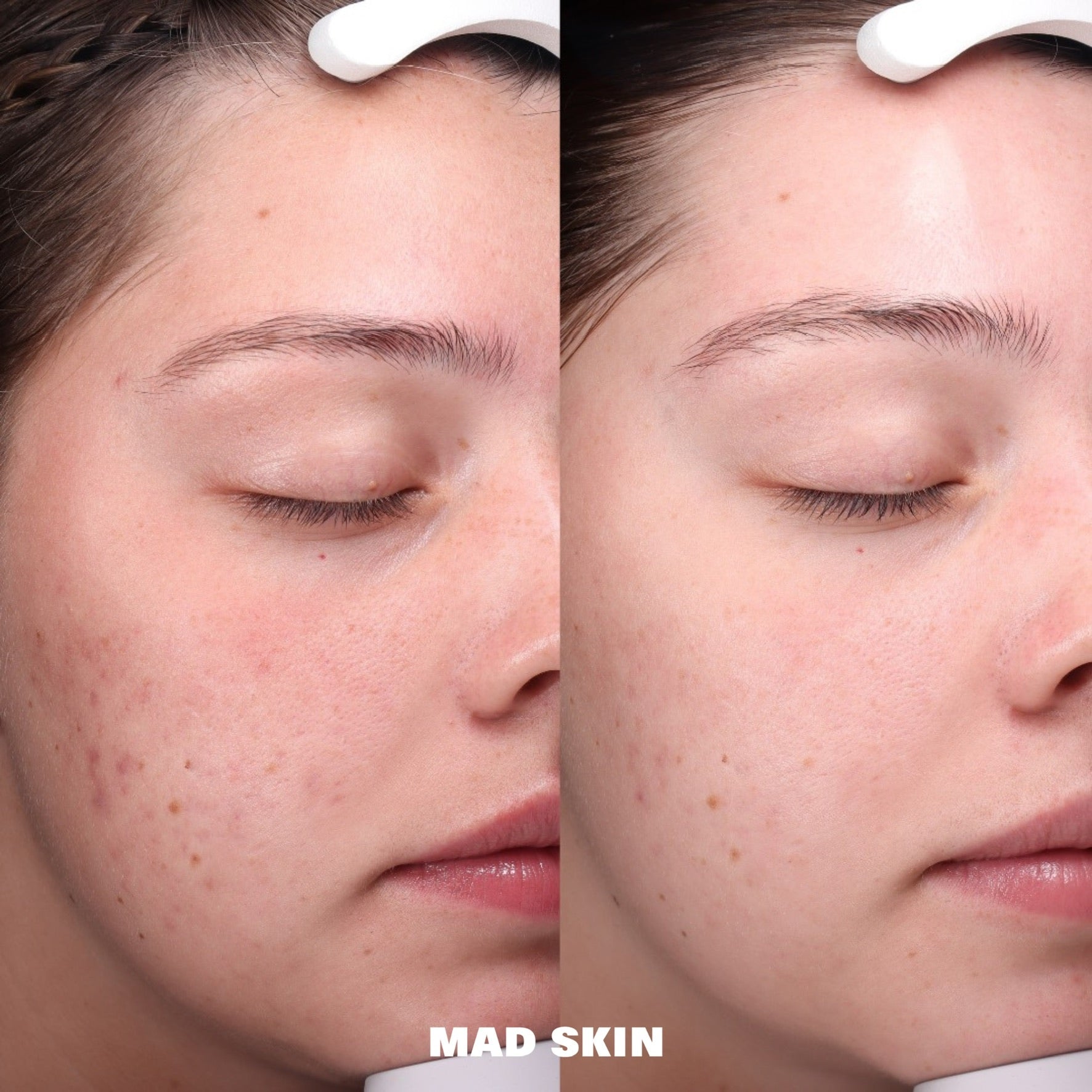 Microneedling Progress