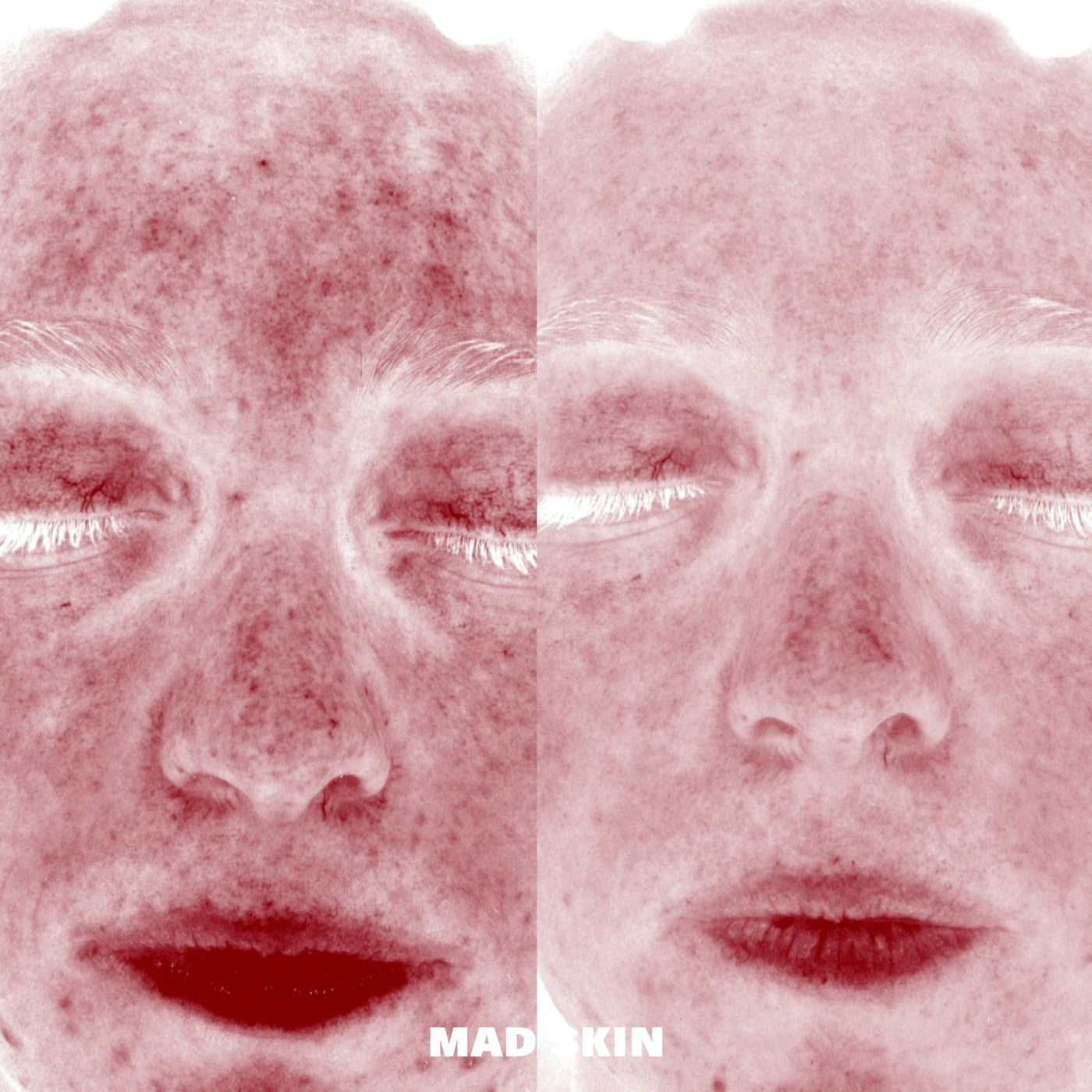 Redness Reduction with ClearSkin Peels