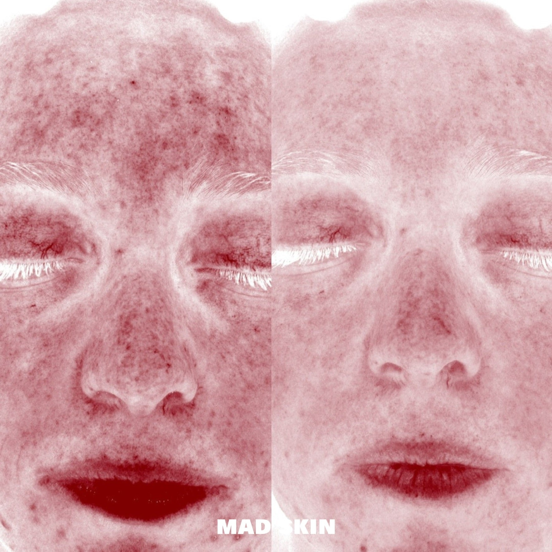 Redness Reduction with ClearSkin Peels