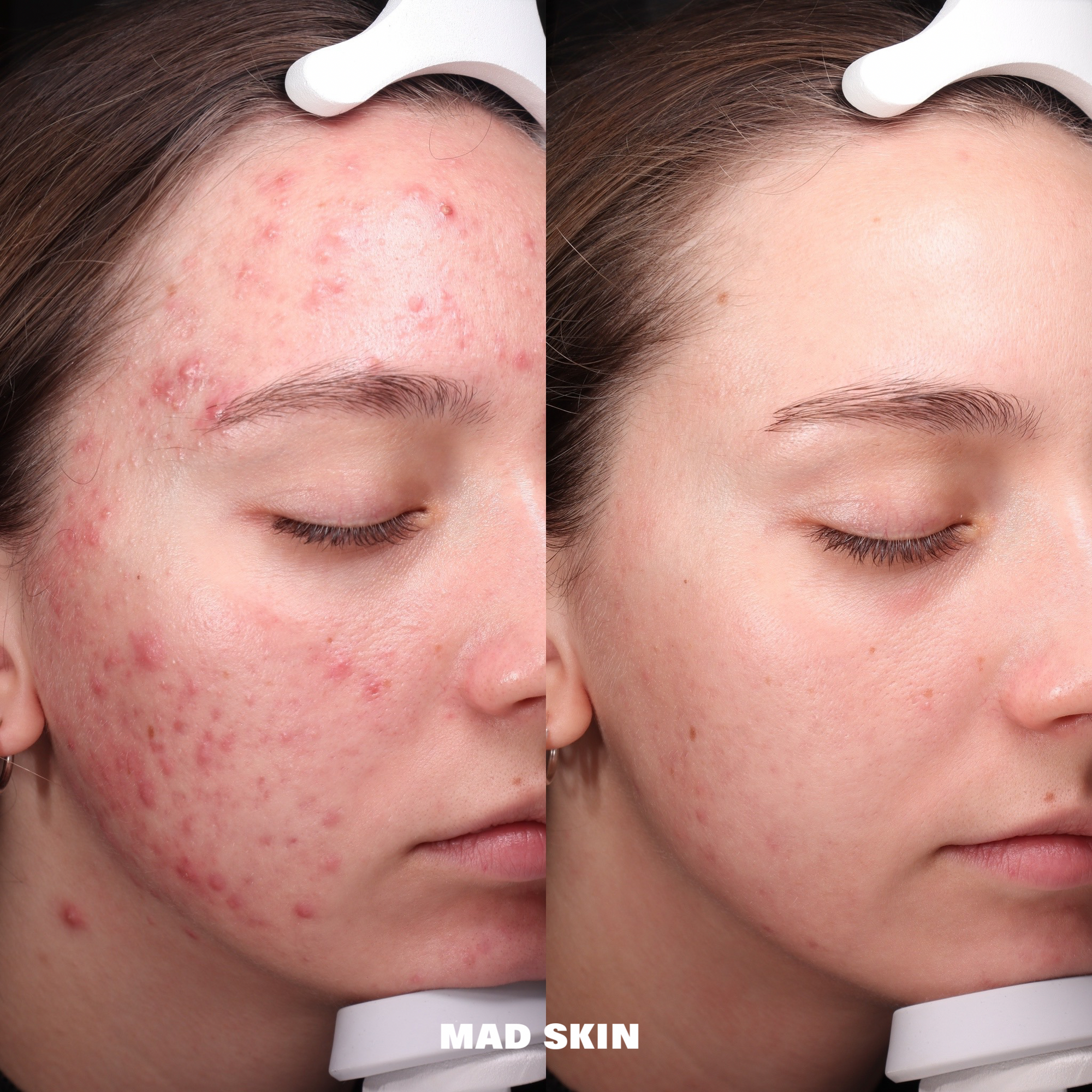 Aerolase ClearSkin Pells + Microneedling