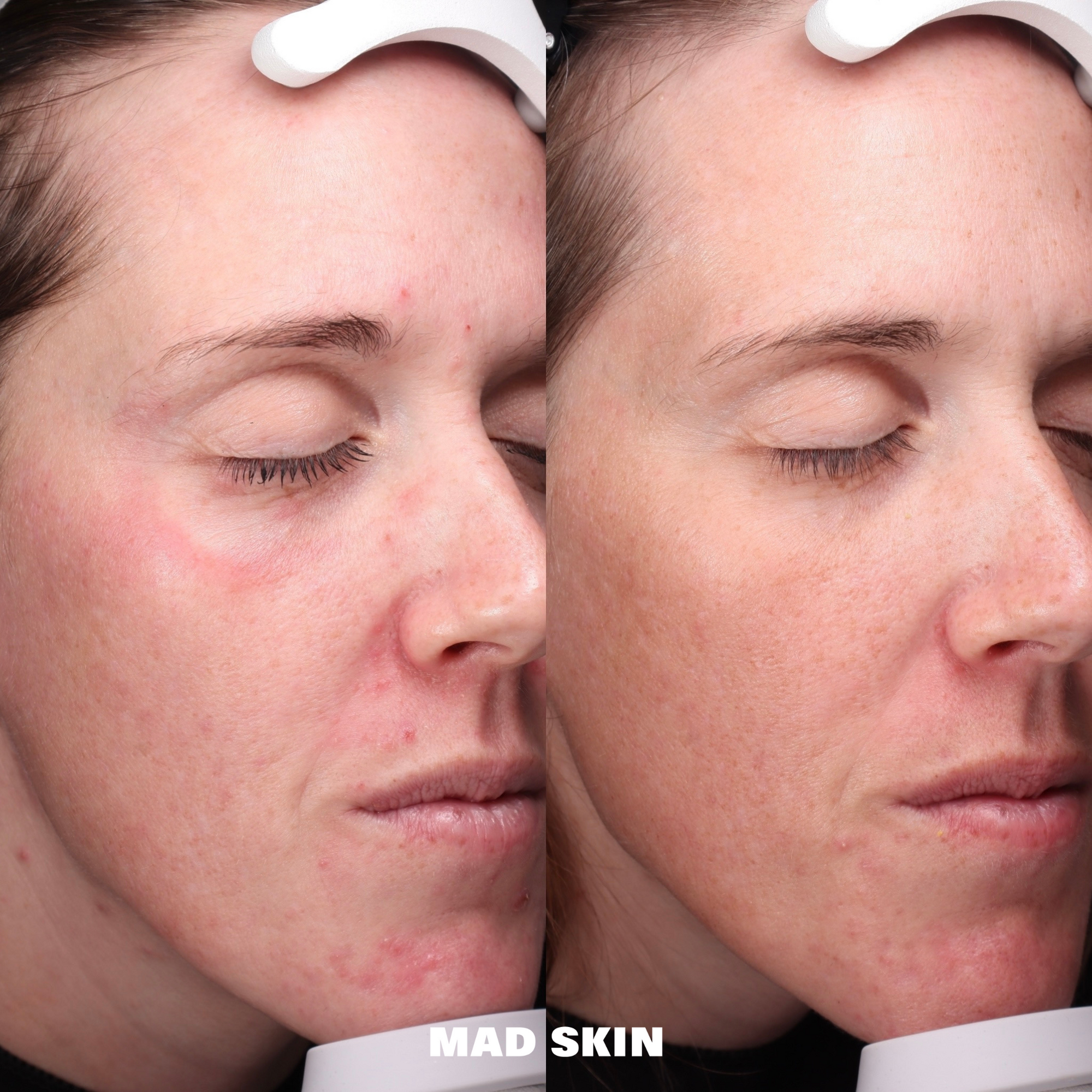 Barrier Repair with Customized Home Care