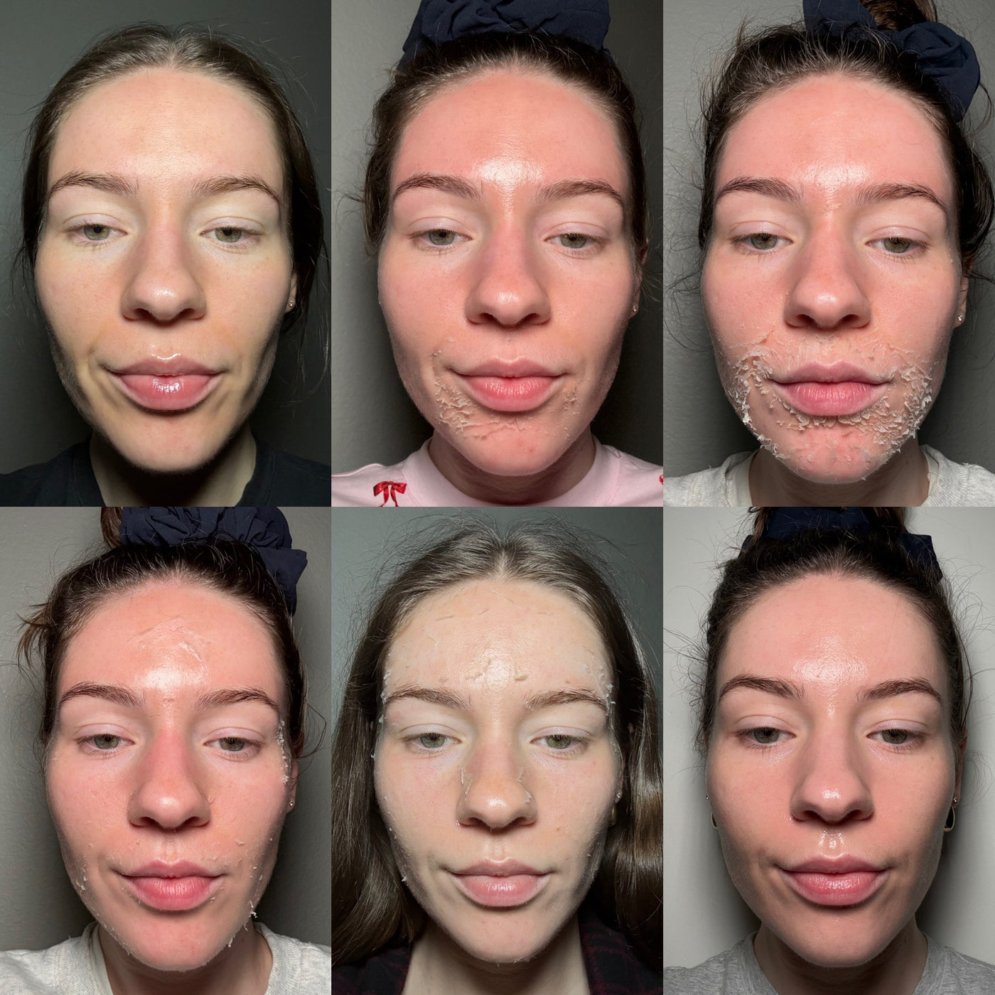 PerfectDerma Peel - Day by Day