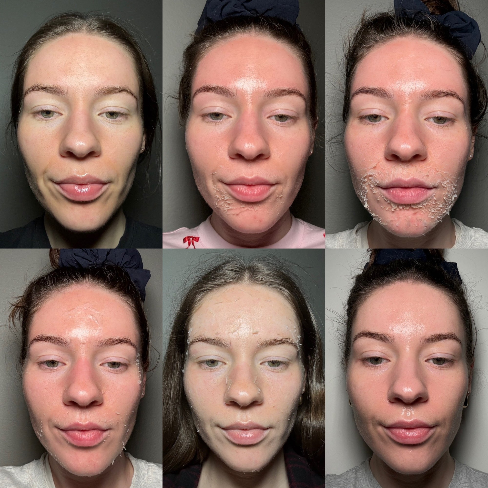 PerfectDerma Peel - Day by Day