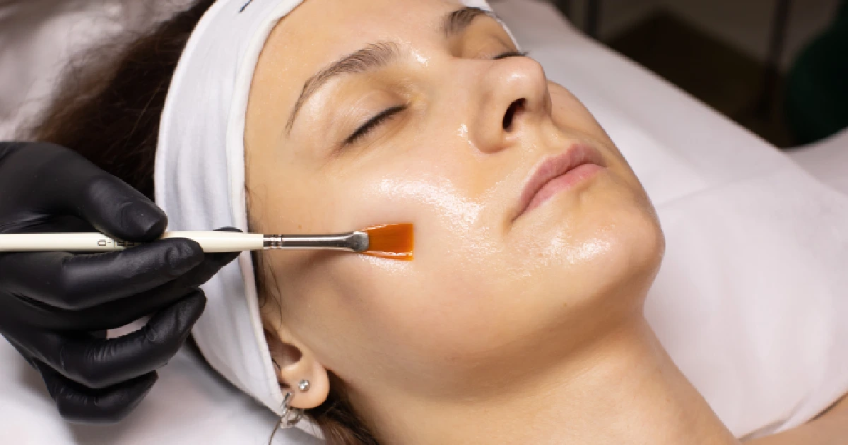 A woman receiving Chemical Peel in Lehi, UT