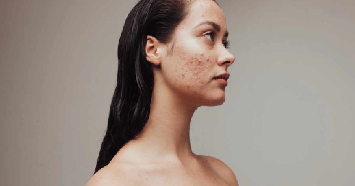 Women receiving Best Acne Treatments for Adults in Utah